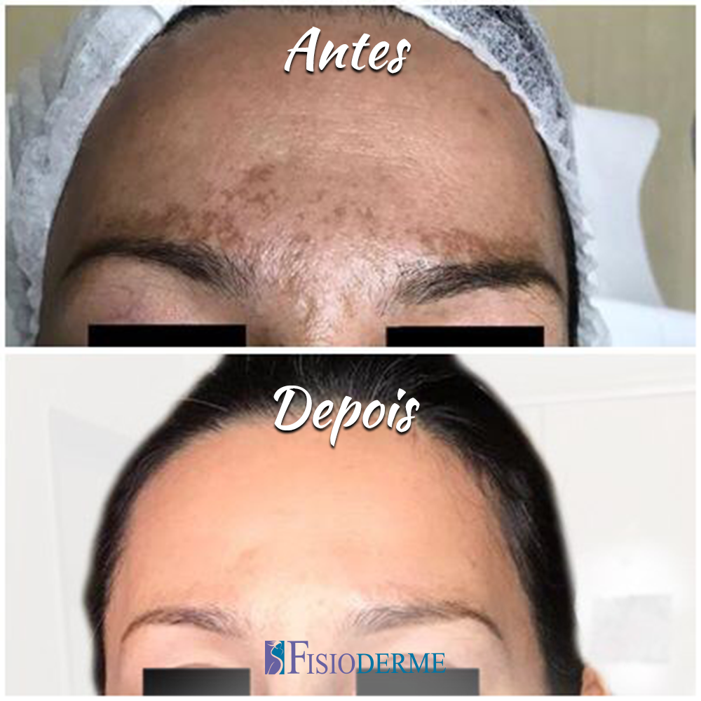 O que é Melasma? Como e Onde Tratar em Brasília DF?