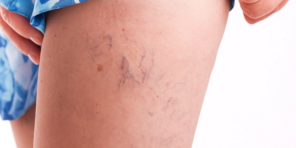 Microvasos, Microvarizes e Varizes - Clínica Fisioderme em Brasília / DF - Candangolândia e Asa Sul