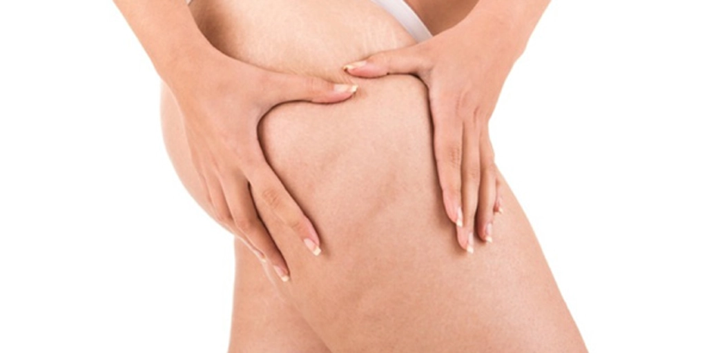 Celulite - Clínica Fisioderme em Brasília / DF - Candangolândia e Asa Sul
