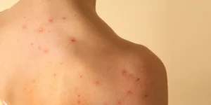 Foliculite - Clínica Fisioderme em Brasília / DF - Candangolândia e Asa Sul