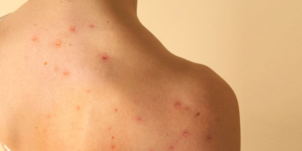 Foliculite - Clínica Fisioderme em Brasília / DF - Candangolândia e Asa Sul