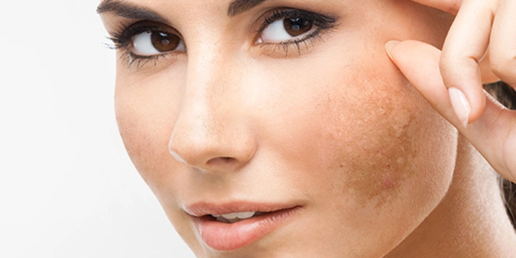 Melasma - Clínica Fisioderme em Brasília / DF - Candangolândia e Asa Sul