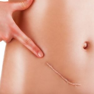 Como Tratar Cicatrizes em Brasília DF / Candangolândia / Asa Sul - Clínica Fisioderme Estética Avançada