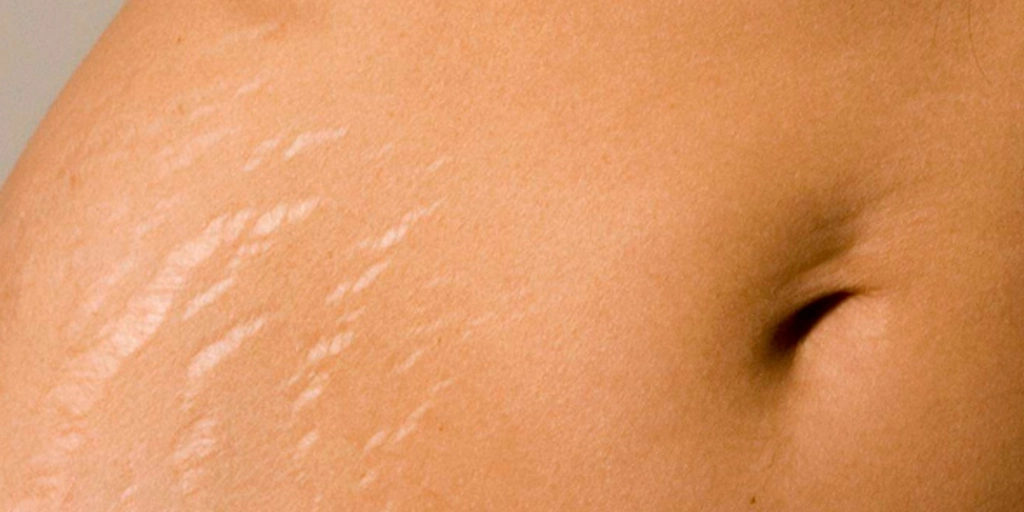 Estrias - Clínica Fisioderme em Brasília / DF - Candangolândia e Asa Sul