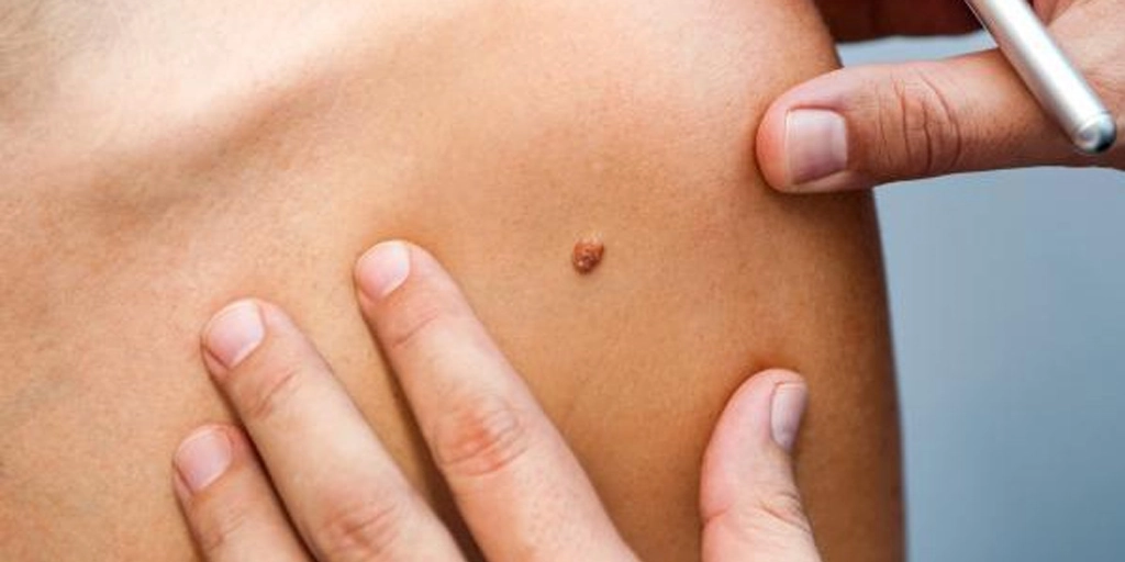 Nevos, Pintas, Sinais e Verrugas - Clínica Fisioderme em Brasília / DF - Candangolândia e Asa Sul
