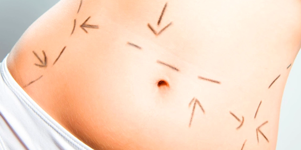 Fibrose de Pós-Operatório - Clínica Fisioderme em Brasília / DF - Candangolândia e Asa Sul