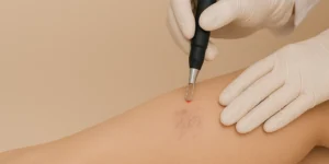 Aplicação de laser transdérmico para microvasos na perna, tratamento estético realizado na Clínica Fisioderme em Brasília