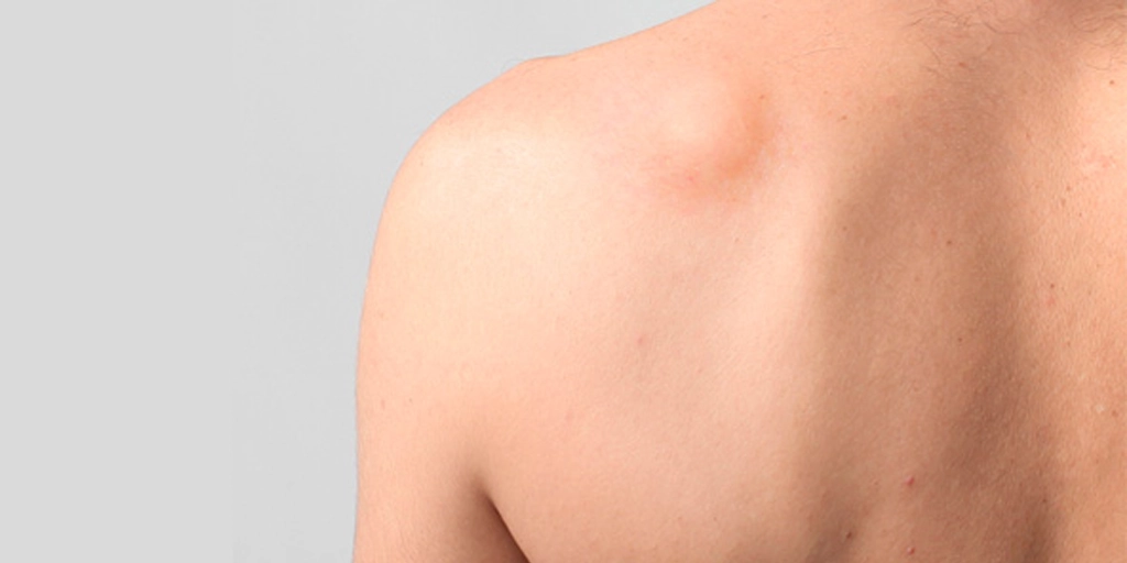 Lipoma - Clínica Fisioderme em Brasília / DF - Candangolândia e Asa Sul