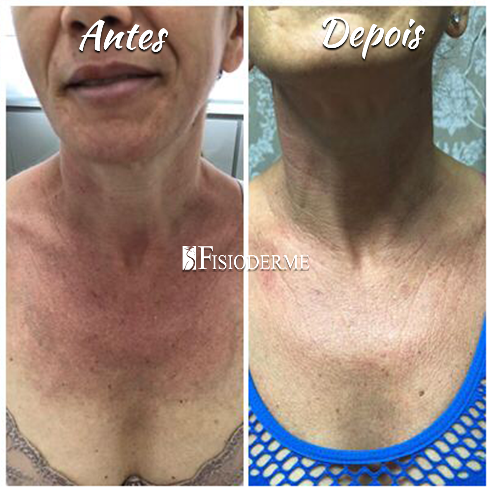 Tratamento de poiquilodermia com laser no colo e pescoço para rejuvenescimento