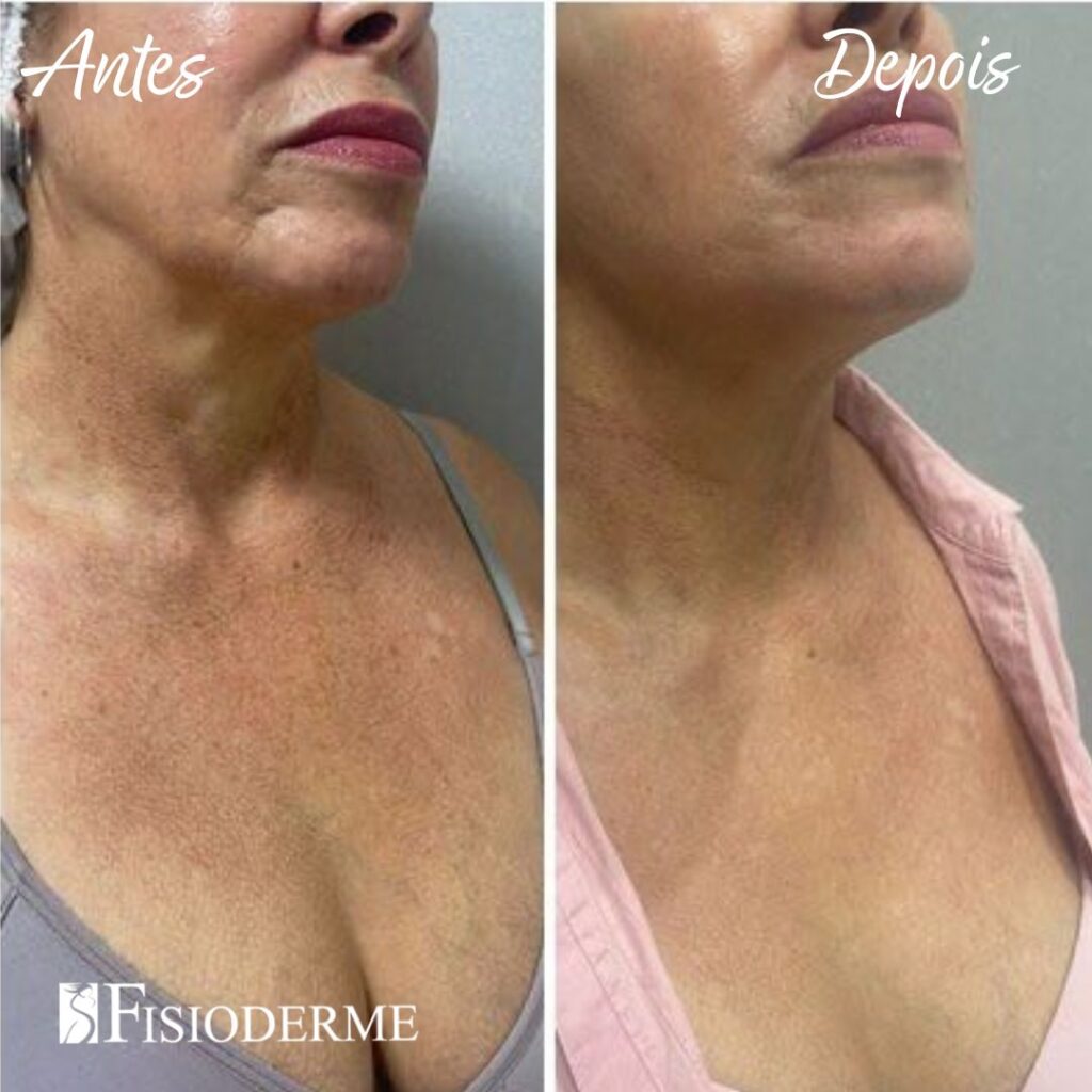 Tratamento de poiquilodermia com laser no colo e pescoço para rejuvenescimento