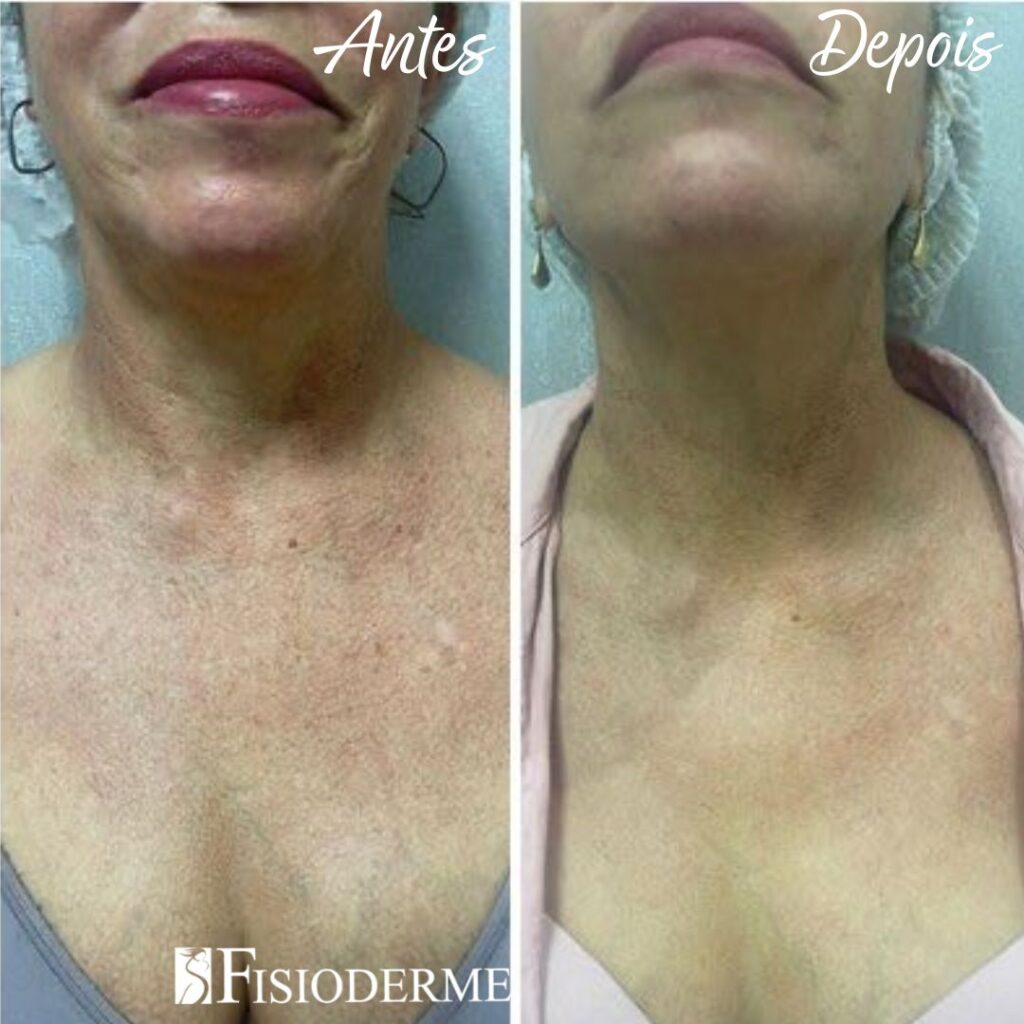 Tratamento de poiquilodermia com laser no colo e pescoço para rejuvenescimento