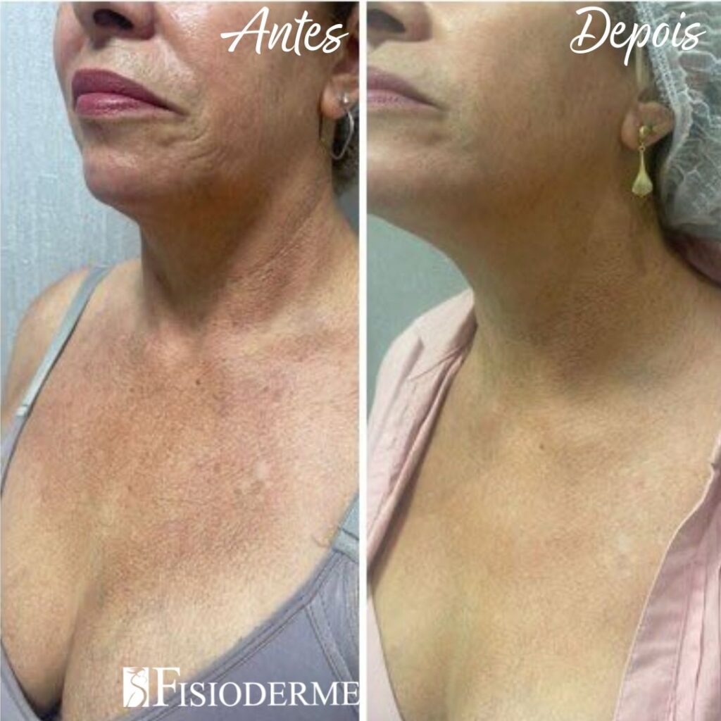 Tratamento de poiquilodermia com laser no colo e pescoço para rejuvenescimento