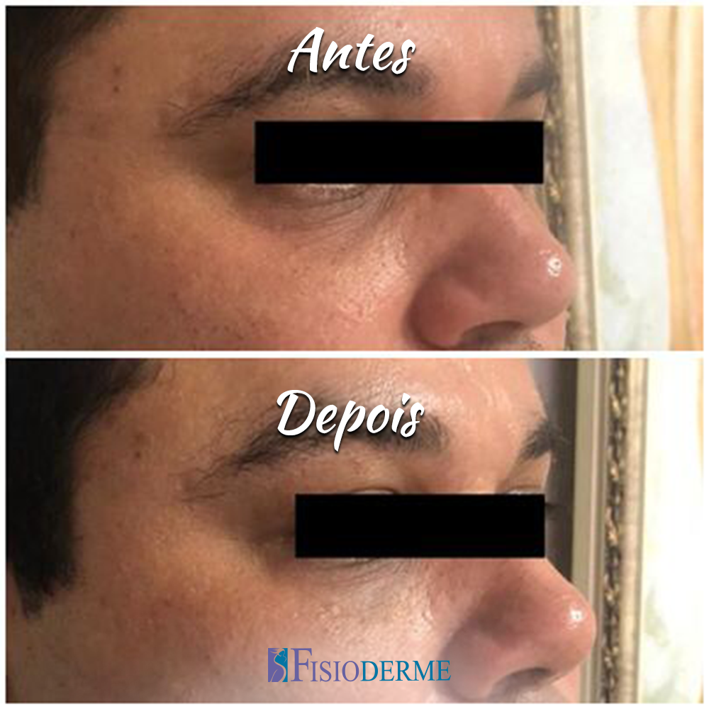 Olheiras ou Olhos Fundos: Antes e depois do tratamento para olheiras com ácido hialurônico na Clínica Fisioderme em Brasília