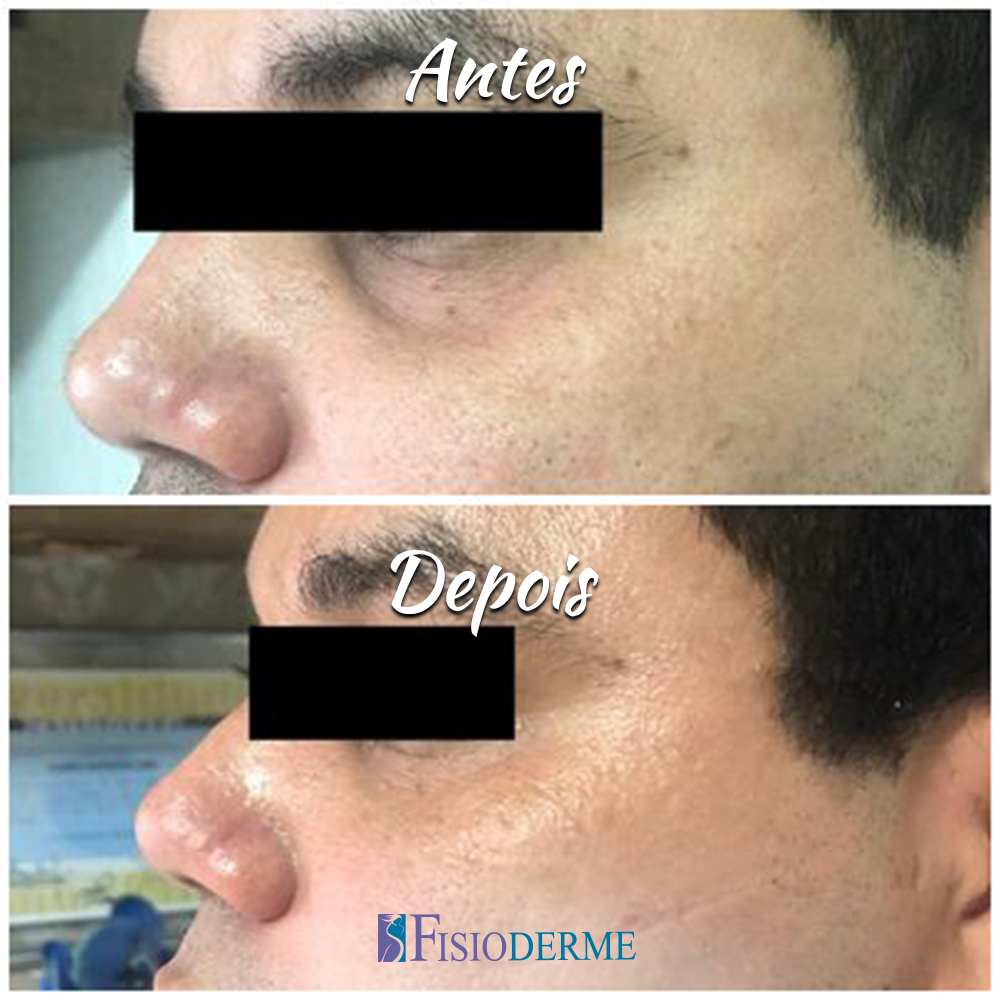 Olheiras ou Olhos Fundos: Antes e depois do tratamento para olheiras com ácido hialurônico na Clínica Fisioderme em Brasília