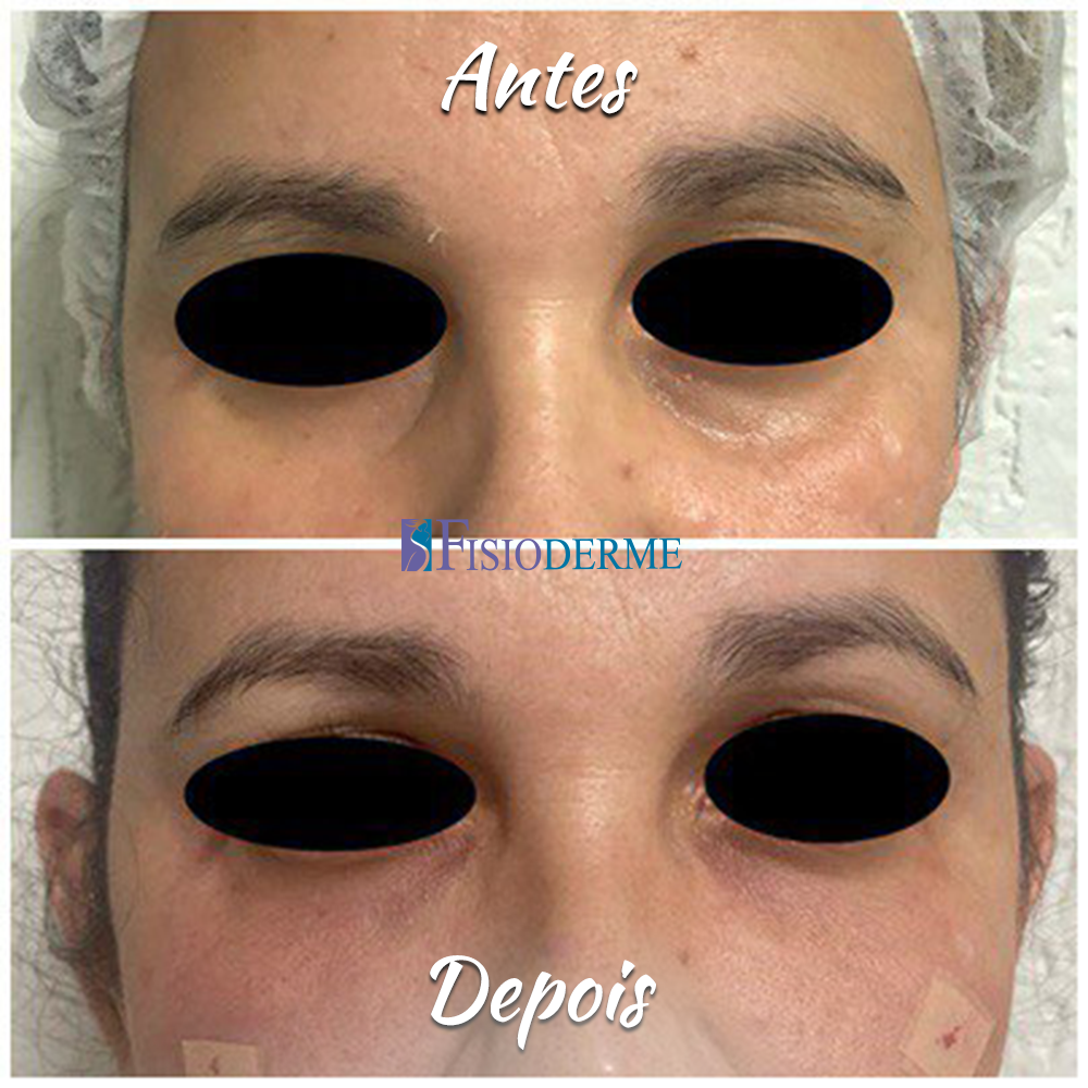 Olheiras ou Olhos Fundos: Antes e depois do tratamento para olheiras com ácido hialurônico na Clínica Fisioderme em Brasília
