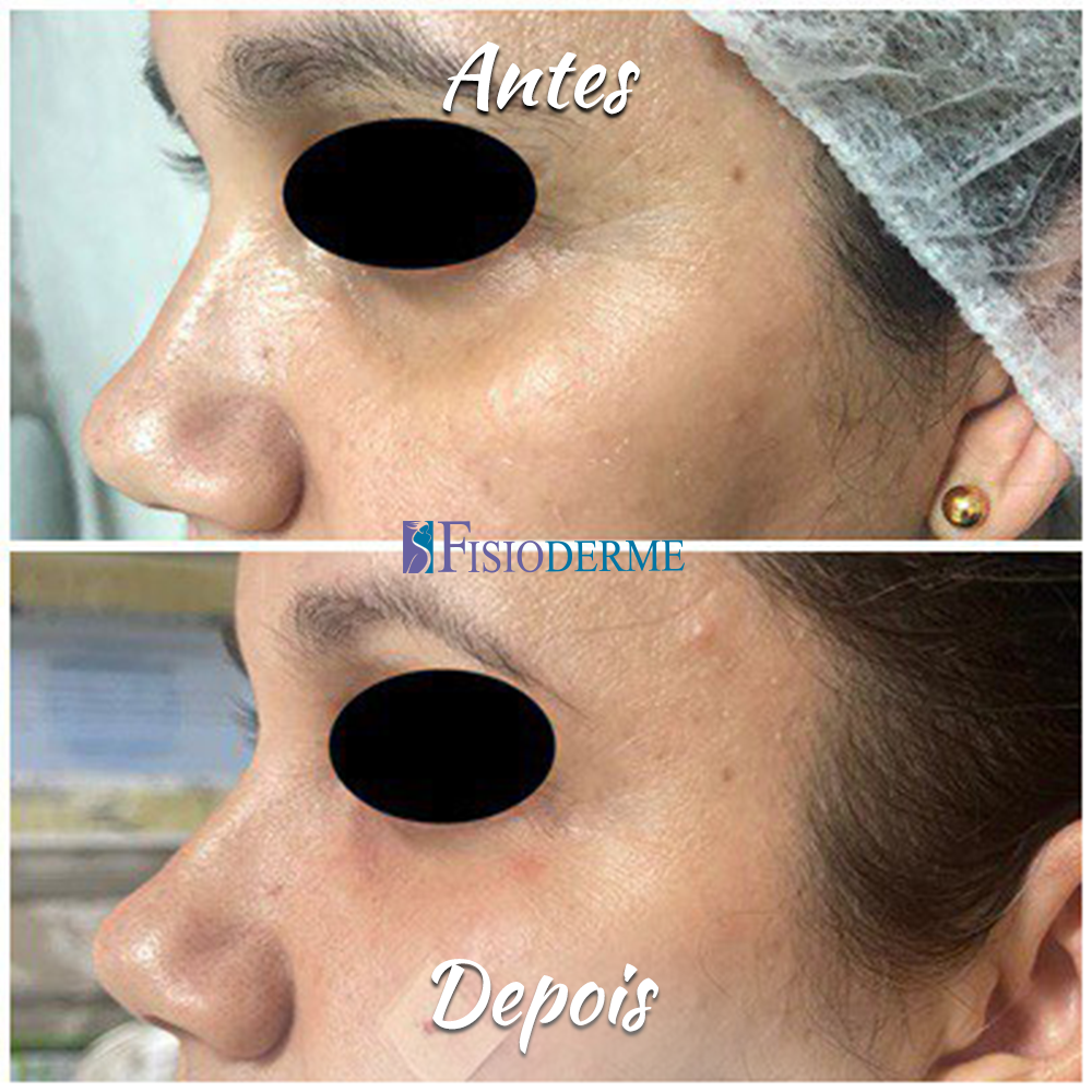 Olheiras ou Olhos Fundos: Antes e depois do tratamento para olheiras com ácido hialurônico na Clínica Fisioderme em Brasília