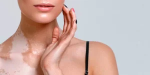 Aplicação de micropigmentação paramédica para camuflagem de manchas brancas