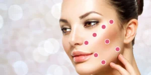 Pontos estratégicos para Lifting Facial MD Codes desenvolvidos por Dr. Maurício de Maio