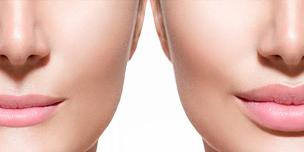 Paciente sorrindo após procedimento de Lip Lift em Brasília DF