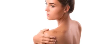 Aplicação de laser Picosure no tratamento de cicatriz hipertrófica na Clínica Fisioderme em Brasília.