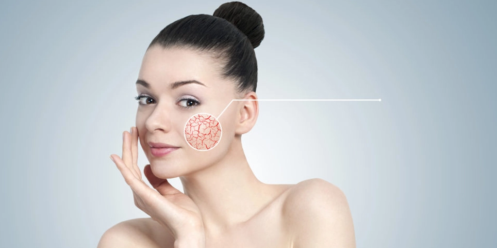 Tratamento a laser para vasinhos no rosto na Clínica Fisioderme em Brasília