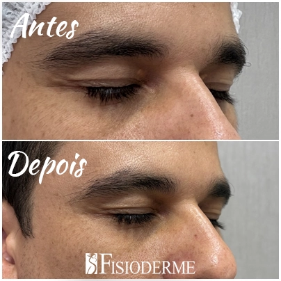 Xantelasma Palpebral - Clínica Fisioderme em Brasília / DF - Candangolândia e Asa Sul