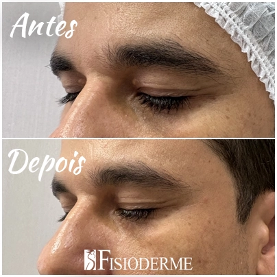 Xantelasma Palpebral - Clínica Fisioderme em Brasília / DF - Candangolândia e Asa Sul