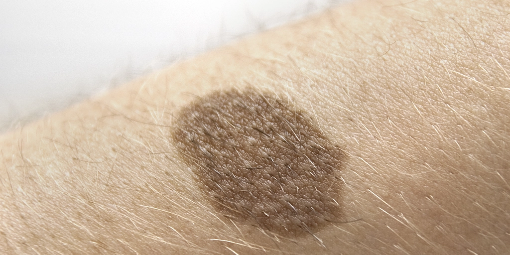 Nevo de Becker - Clínica Fisioderme em Brasília / DF - Candangolândia e Asa Sul