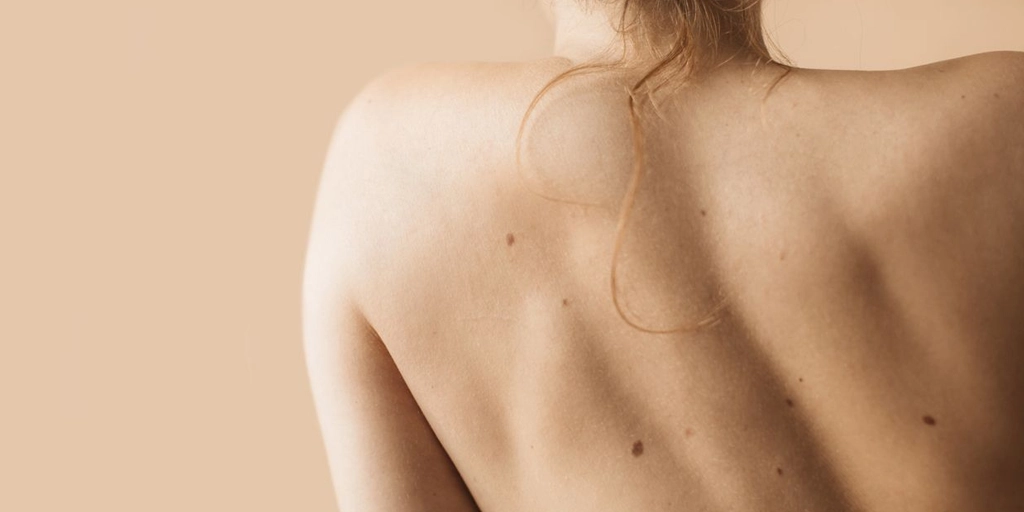 Nevo de Ota, Nevo de Ito, Nevo de Hori e Mancha de Nascença - Clínica Fisioderme em Brasília / DF - Candangolândia e Asa Sul