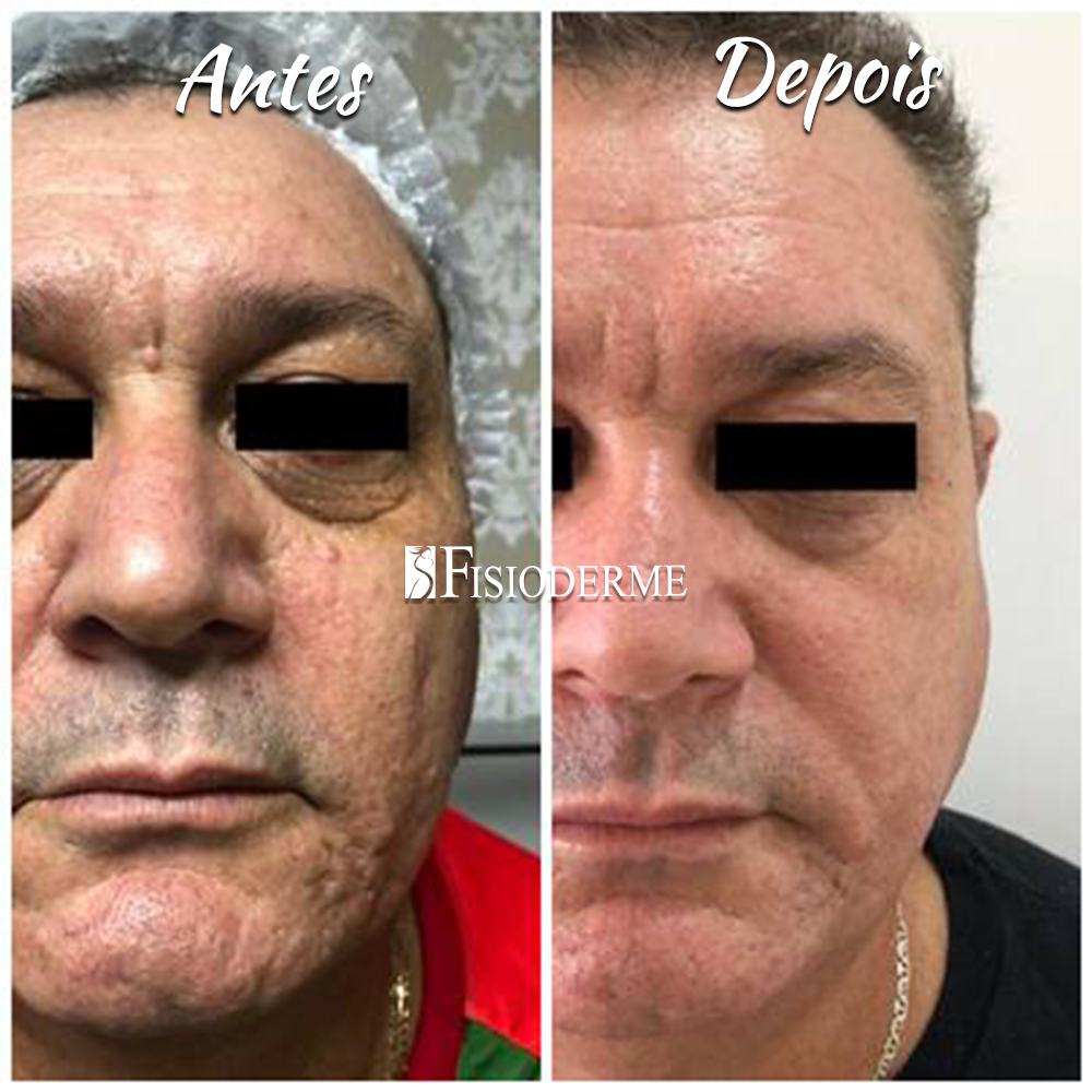 Plasma Lift Inovação em Rejuvenescimento em Brasília