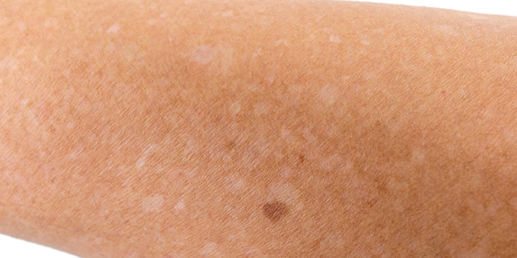 Leucodermia Solar Gutata / Sardas Brancas - Clínica Fisioderme em Brasília / DF - Candangolândia e Asa Sul