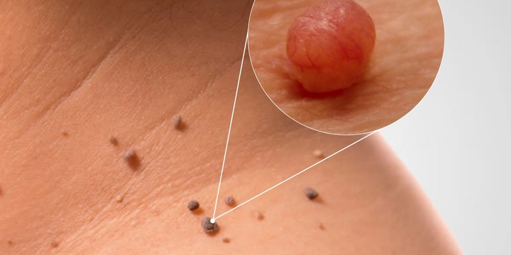 Pólipo Fibroepitelial / Molusco Pêndulo - Clínica Fisioderme em Brasília / DF - Candangolândia e Asa Sul