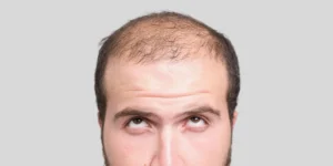 Relação entre testosterona e queda de cabelo masculina
