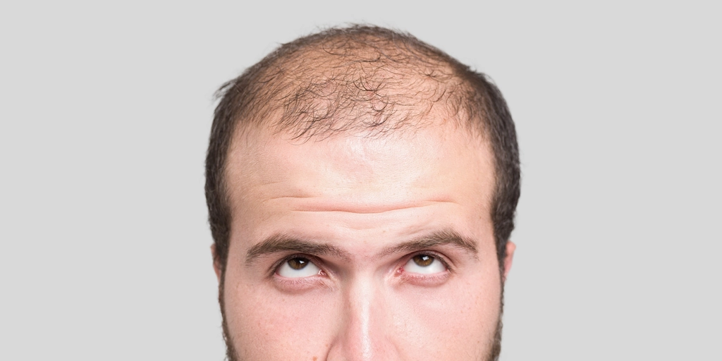 Relação entre testosterona e queda de cabelo masculina