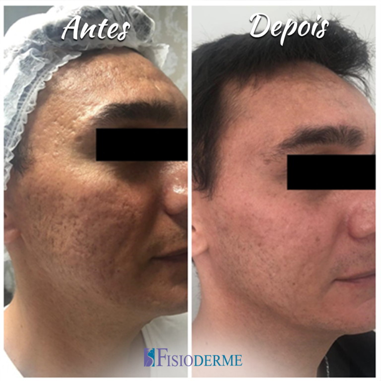 Cicatriz De Acne O Que H De Mais Atual Em Tratamentos