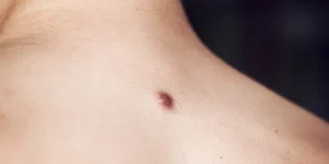 Dermatofibroma - Clínica Fisioderme em Brasília / DF - Candangolândia e Asa Sul