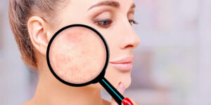 Mulher sorrindo após tratamento para cicatrizes de acne na clínica Fisioderme.