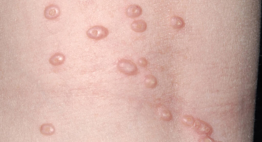 Infecção do Molusco Contagioso