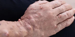 Paciente com nódulos de neurofibromatose visíveis na pele