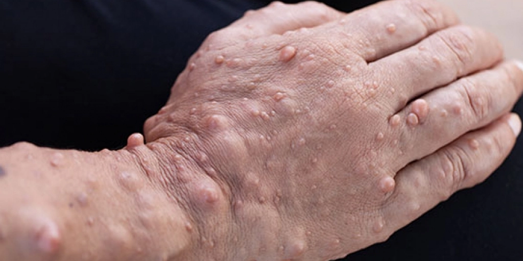 Paciente com nódulos de neurofibromatose visíveis na pele