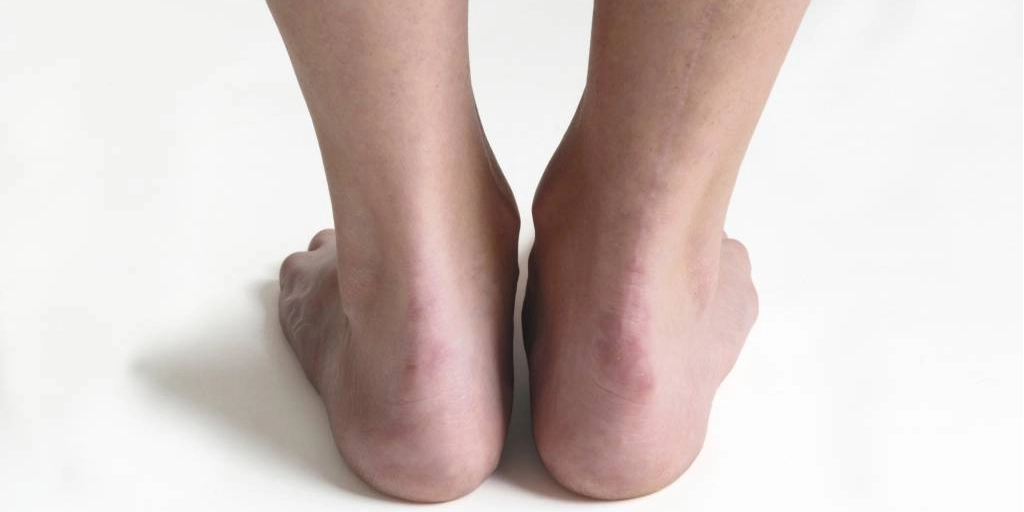 Aplicação de PRP para regeneração do tendão de Aquiles em clínica especializada