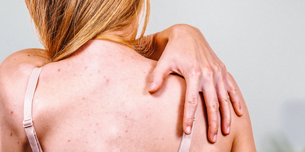 Paciente com espinhas nas costas