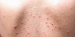 Espinhas nas costas sendo tratadas em clínica estética especializada