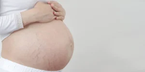 Mulher grávida aplicando creme hidratante na barriga para prevenir estrias