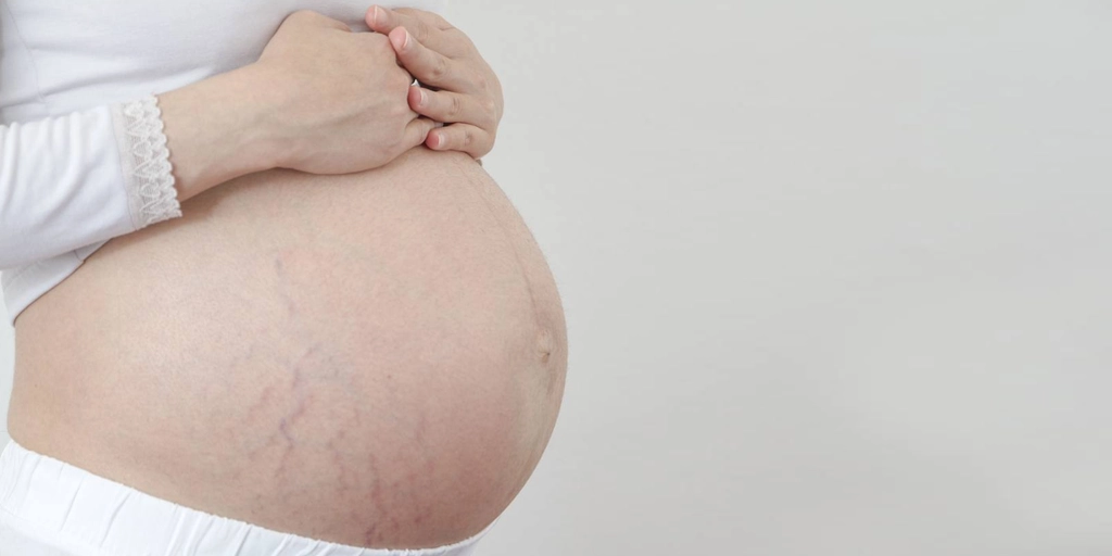 Mulher grávida aplicando creme hidratante na barriga para prevenir estrias