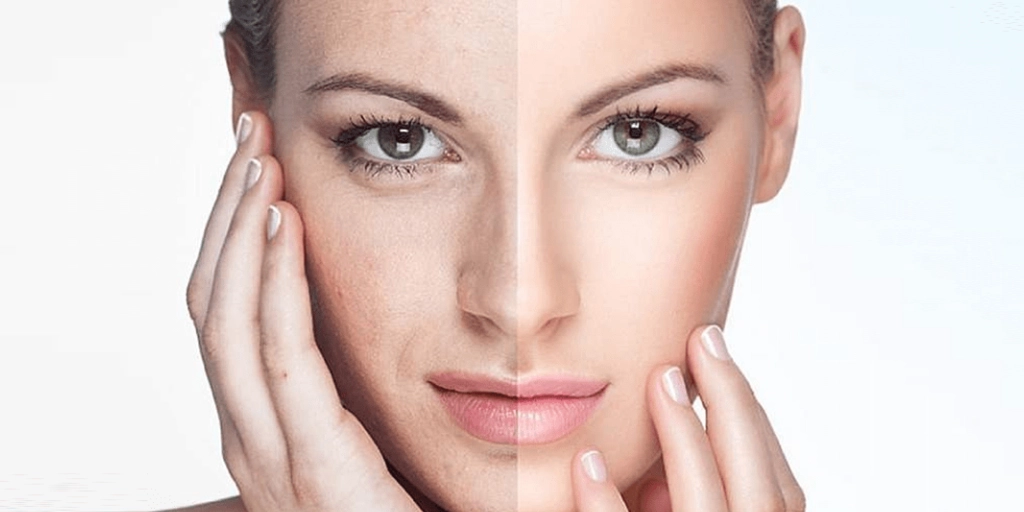 Pele com hiperpigmentação pós inflamatória tratada com laser em clínica de Brasília