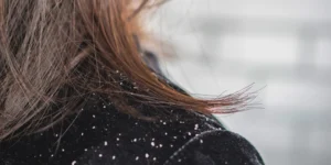 Dermatite Seborreica Descontrolada - Clínica Fisioderme em Brasília / DF - Candangolândia e Asa Sul