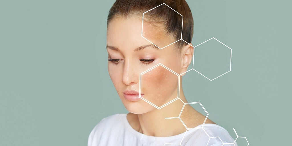 Mulher com pele saudável protegida contra melasma usando chapéu e protetor solar