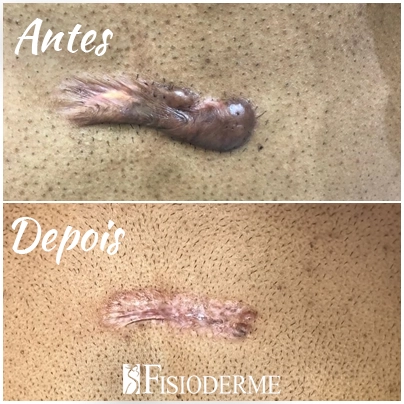 Aplicação de laser Picosure em queloide durante tratamento dermatológico