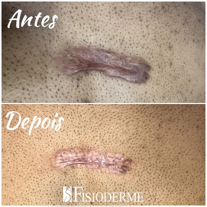 Aplicação de laser Picosure em queloide durante tratamento dermatológico